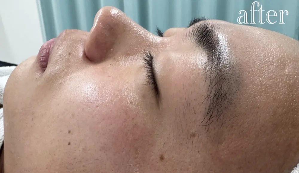 ホワイトラボでフェイスワックス行った後の左頬(1回目)