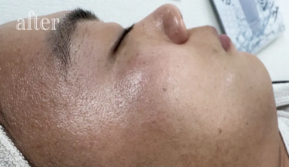 ホワイトラボでフェイスワックス行った後の右頬(1回目)