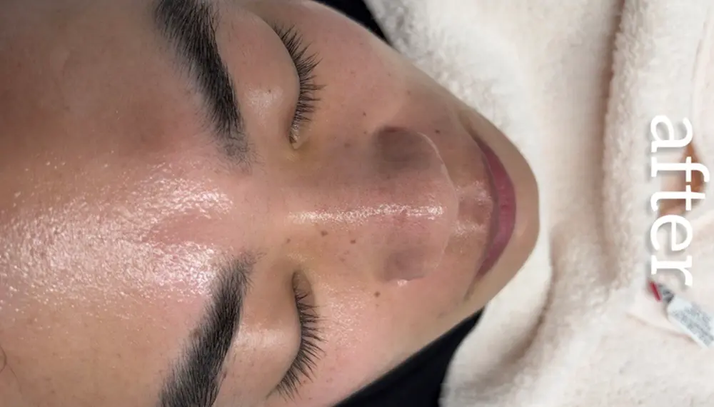 ホワイトラボでフェイスワックス行った後の顔全体(8回目)