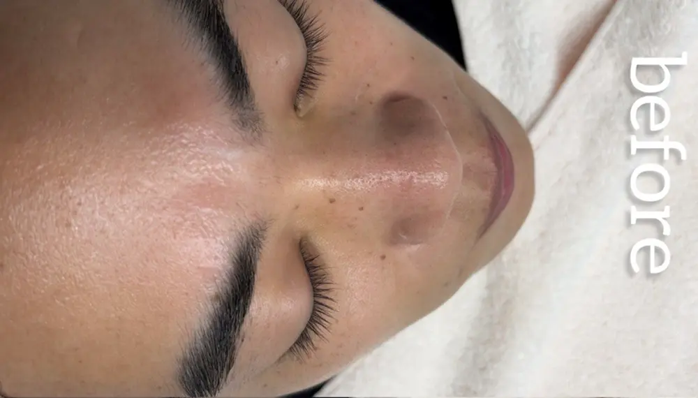 ホワイトラボでフェイスワックス行う前の顔全体(8回目)