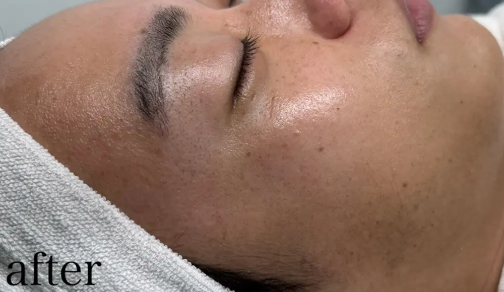 ホワイトラボでフェイスワックス行った後の右半分の顔(7回目)