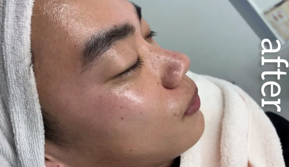 ホワイトラボでフェイスワックス行った後の右半分の顔(8回目)