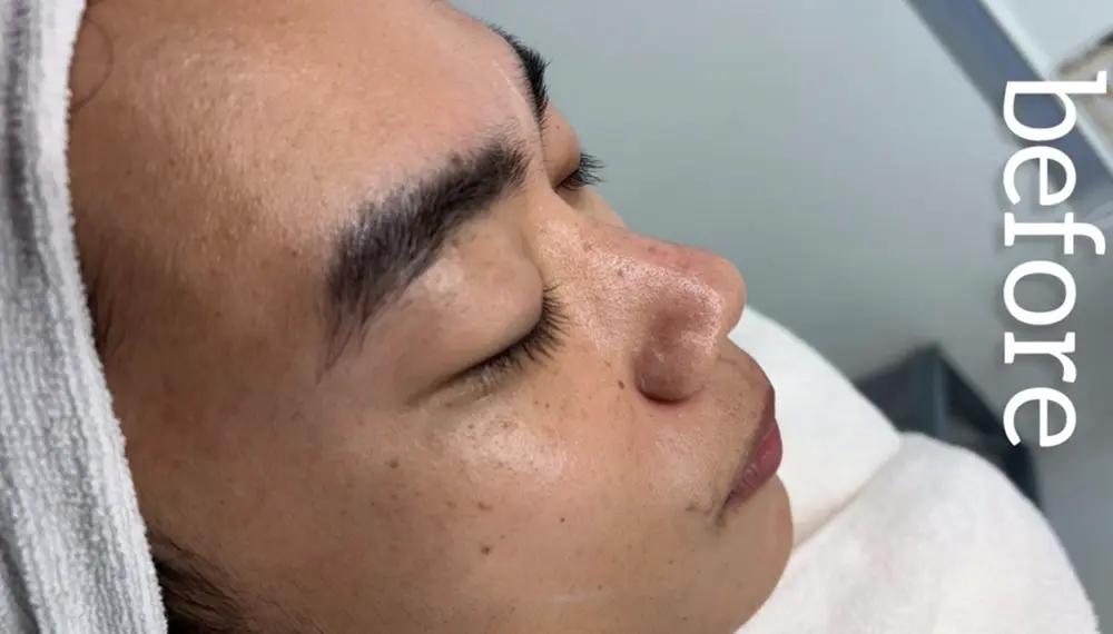 ホワイトラボでフェイスワックス行う前の右半分の顔(8回目)